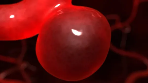 Beyin Anevrizması Nedir?